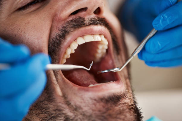 Best Emergency Dentist for Lost Fillings or Crowns in Hiram, GA